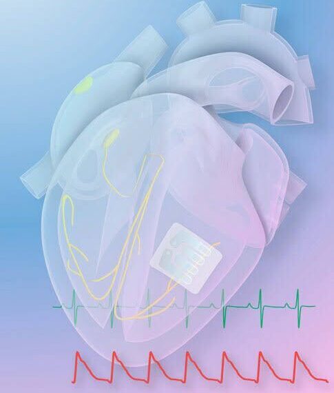 Revolutionizing Heart Health: Exploring the Graphene ‘Tattoo’ Implant for Cardiac Arrhythmia Treatment